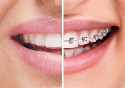 Clear Aligners vs Braces: A Complete Guide for 2026